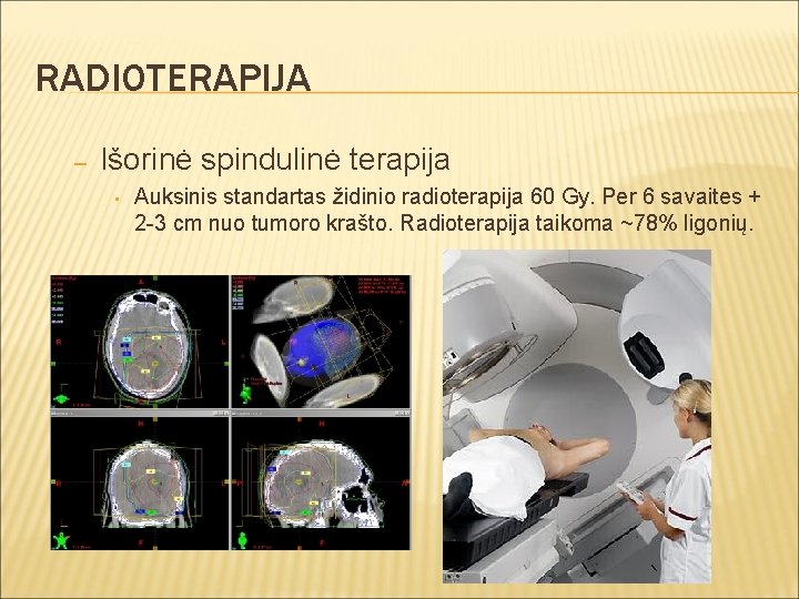 RADIOTERAPIJA – Išorinė spindulinė terapija • Auksinis standartas židinio radioterapija 60 Gy. Per 6