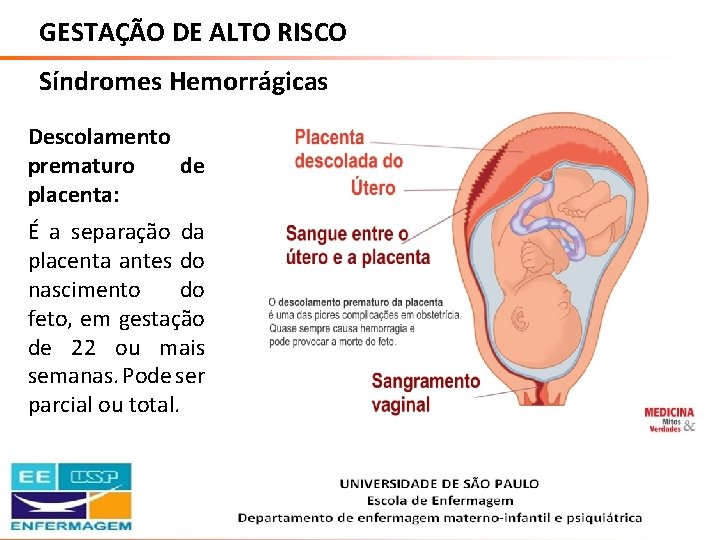 GESTAÇÃO DE ALTO RISCO Síndromes Hemorrágicas Descolamento prematuro de placenta: É a separação da