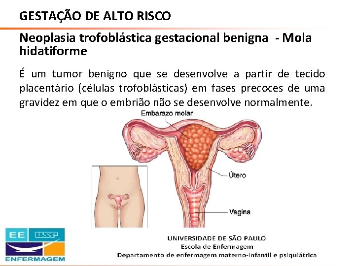 GESTAÇÃO DE ALTO RISCO Neoplasia trofoblástica gestacional benigna - Mola hidatiforme É um tumor