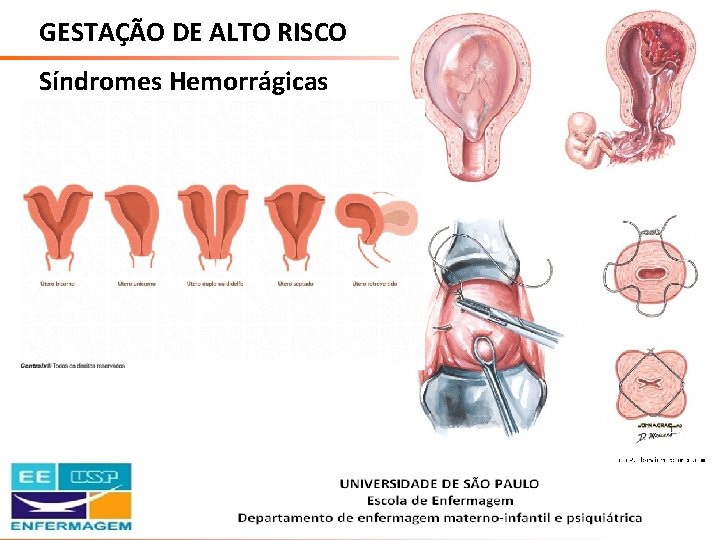 GESTAÇÃO DE ALTO RISCO Síndromes Hemorrágicas Saúde da Mulher • Profa. Dra. Carla Marins