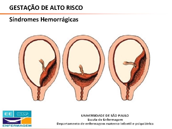 GESTAÇÃO DE ALTO RISCO Síndromes Hemorrágicas Saúde da Mulher • Profa. Dra. Carla Marins