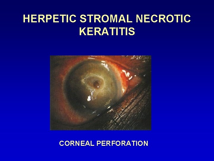 HERPETIC STROMAL NECROTIC KERATITIS CORNEAL PERFORATION 