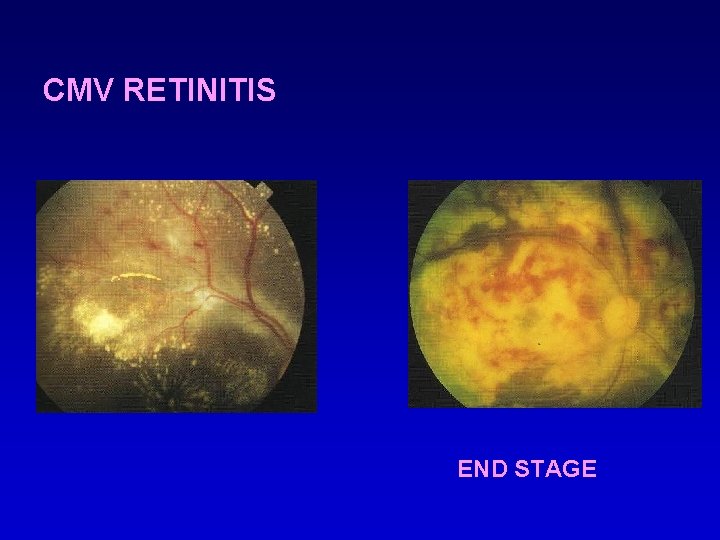 CMV RETINITIS END STAGE 