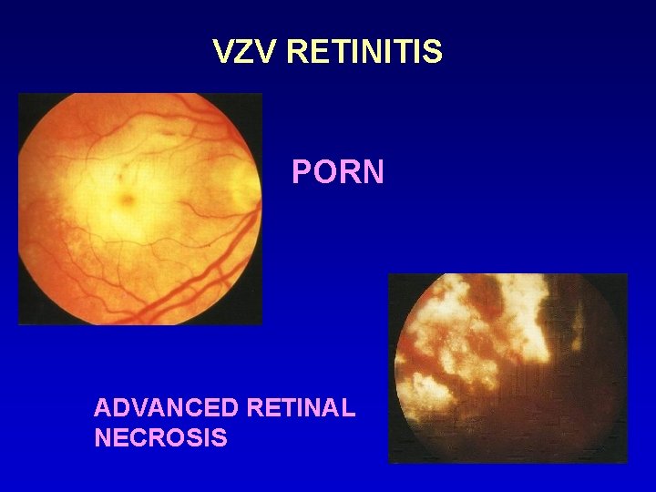 VZV RETINITIS PORN ADVANCED RETINAL NECROSIS 