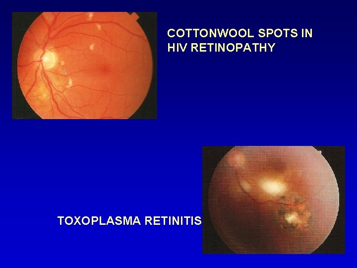 COTTONWOOL SPOTS IN HIV RETINOPATHY TOXOPLASMA RETINITIS 