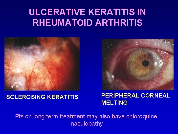 ULCERATIVE KERATITIS IN RHEUMATOID ARTHRITIS SCLEROSING KERATITIS PERIPHERAL CORNEAL MELTING Pts on long term