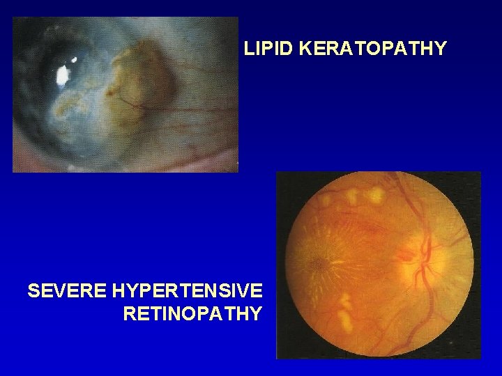 LIPID KERATOPATHY SEVERE HYPERTENSIVE RETINOPATHY 