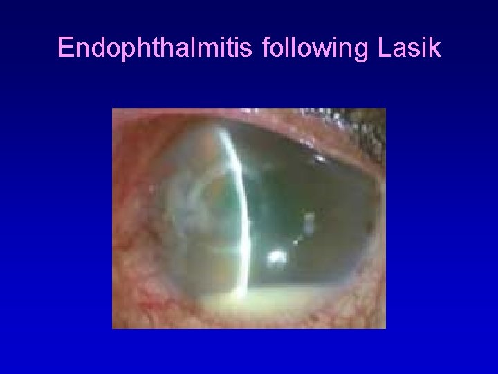 Endophthalmitis following Lasik 