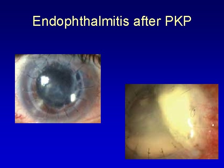 Endophthalmitis after PKP 