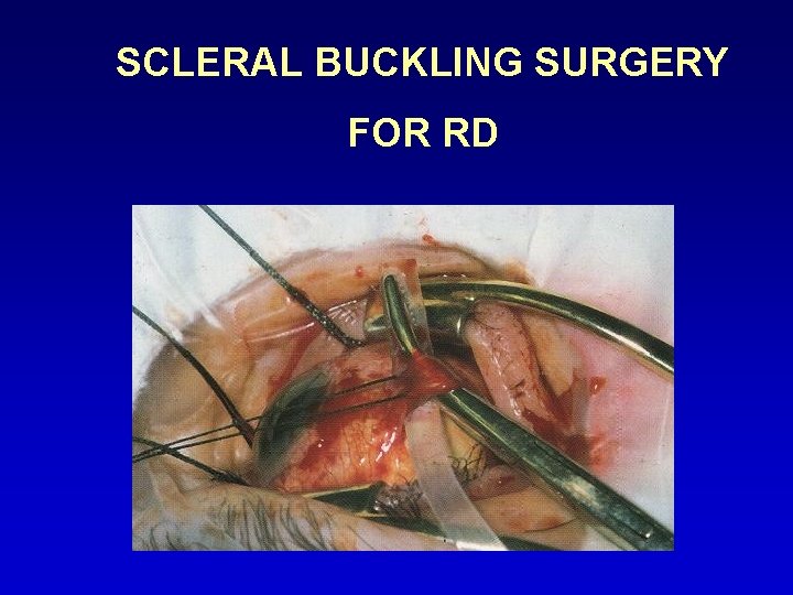SCLERAL BUCKLING SURGERY FOR RD 
