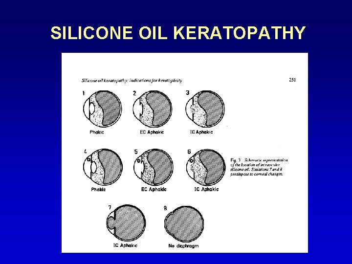 SILICONE OIL KERATOPATHY 