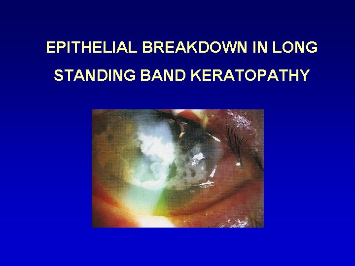 EPITHELIAL BREAKDOWN IN LONG STANDING BAND KERATOPATHY 