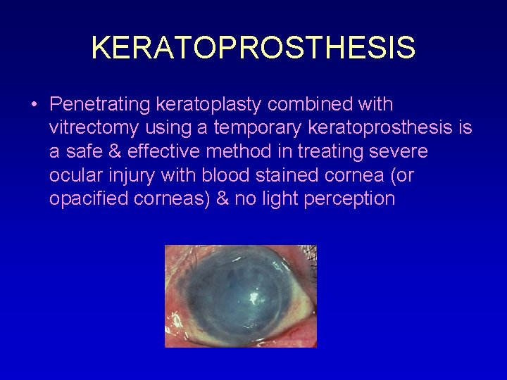 KERATOPROSTHESIS • Penetrating keratoplasty combined with vitrectomy using a temporary keratoprosthesis is a safe