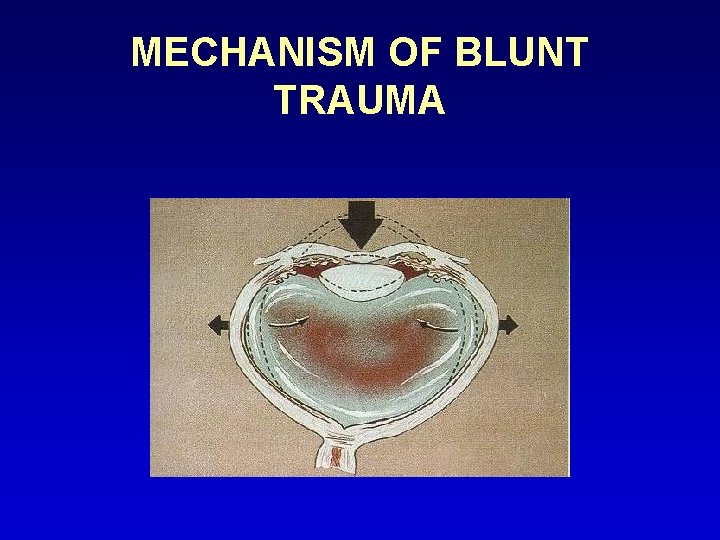 MECHANISM OF BLUNT TRAUMA 