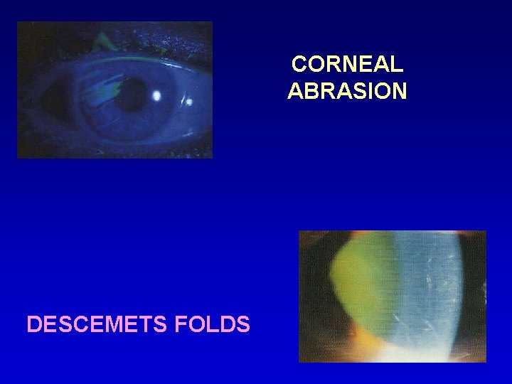 CORNEAL ABRASION DESCEMETS FOLDS 