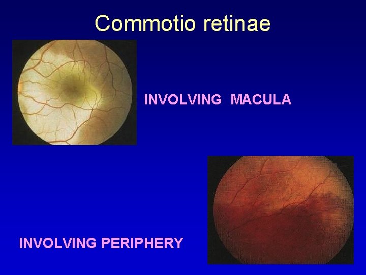 Commotio retinae INVOLVING MACULA INVOLVING PERIPHERY 