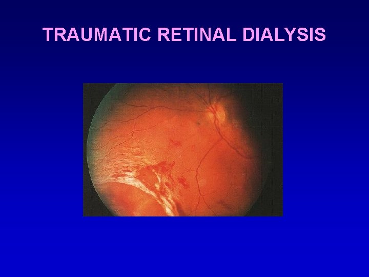 TRAUMATIC RETINAL DIALYSIS 