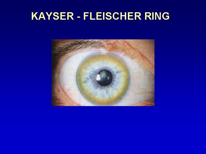 KAYSER - FLEISCHER RING 