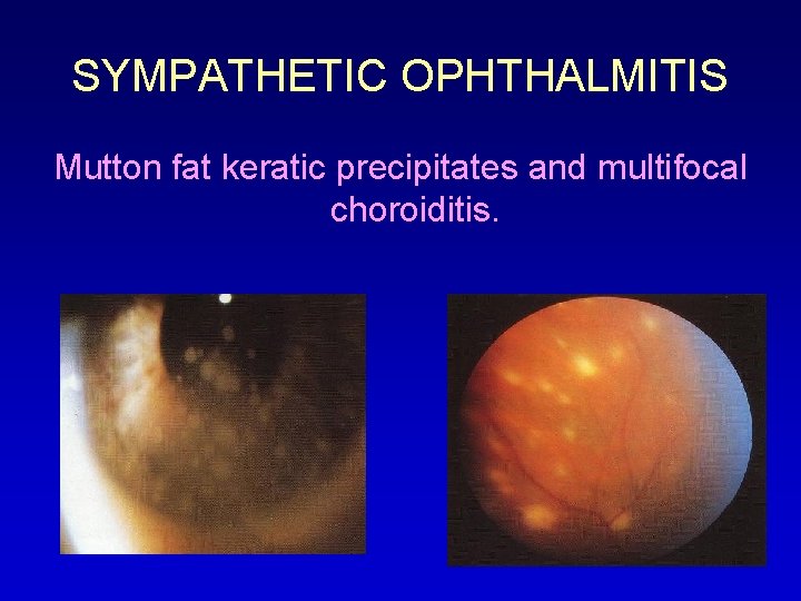 SYMPATHETIC OPHTHALMITIS Mutton fat keratic precipitates and multifocal choroiditis. 