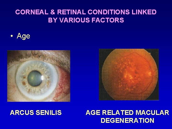 CORNEAL & RETINAL CONDITIONS LINKED BY VARIOUS FACTORS • Age ARCUS SENILIS AGE RELATED