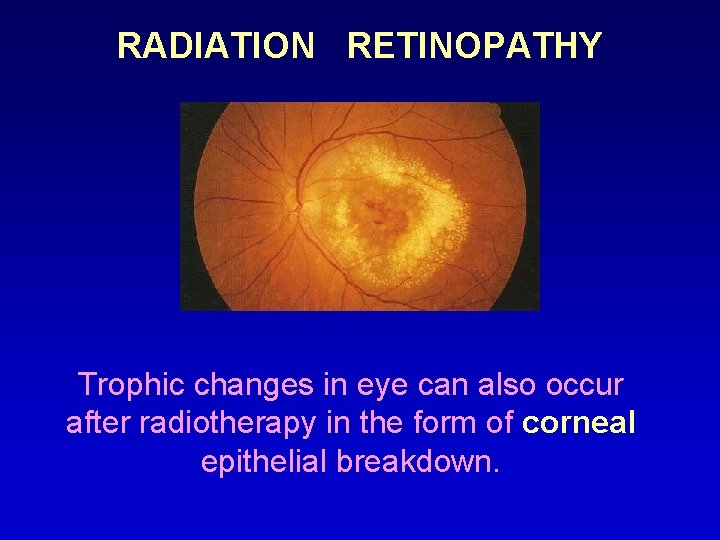 RADIATION RETINOPATHY Trophic changes in eye can also occur after radiotherapy in the form