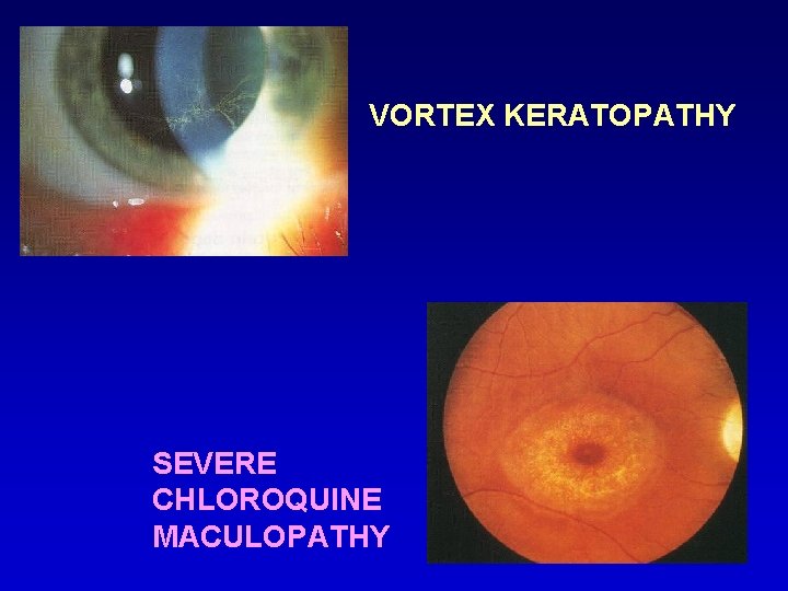 VORTEX KERATOPATHY SEVERE CHLOROQUINE MACULOPATHY 