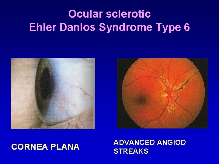 Ocular sclerotic Ehler Danlos Syndrome Type 6 CORNEA PLANA ADVANCED ANGIOD STREAKS 