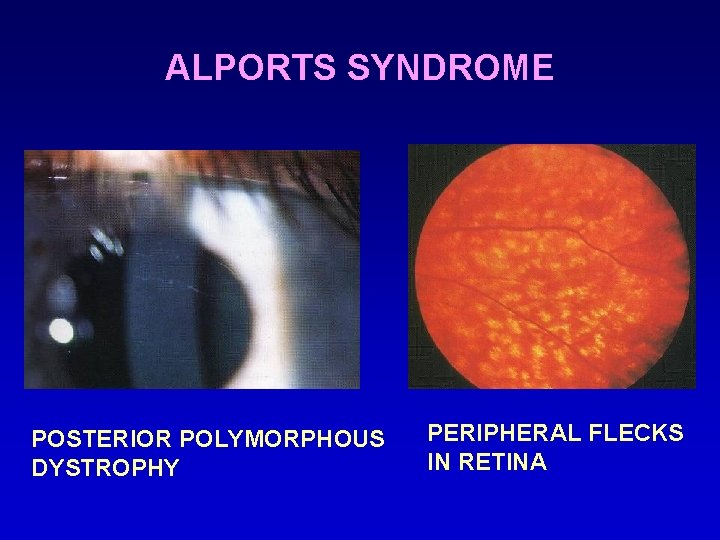 ALPORTS SYNDROME POSTERIOR POLYMORPHOUS DYSTROPHY PERIPHERAL FLECKS IN RETINA 