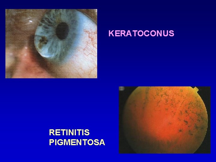 KERATOCONUS RETINITIS PIGMENTOSA 