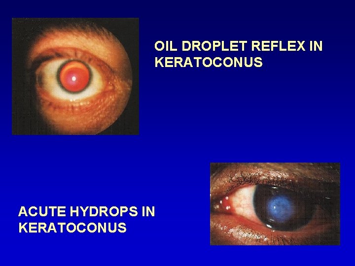 OIL DROPLET REFLEX IN KERATOCONUS ACUTE HYDROPS IN KERATOCONUS 