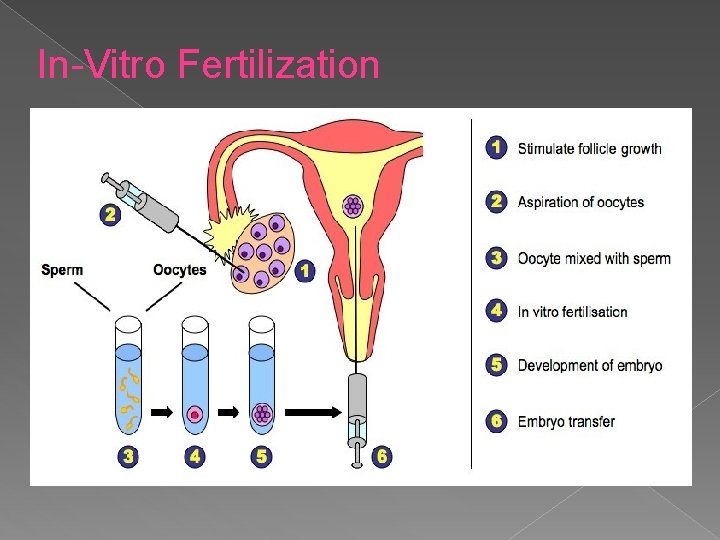 In-Vitro Fertilization 