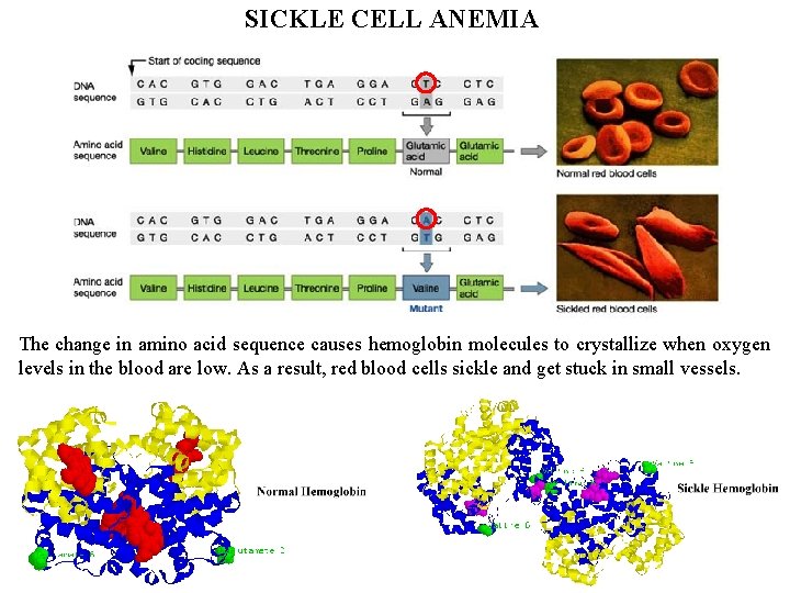 SICKLE CELL ANEMIA The change in amino acid sequence causes hemoglobin molecules to crystallize