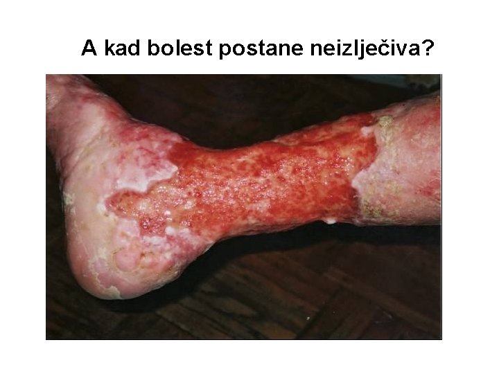 A kad bolest postane neizlječiva? 