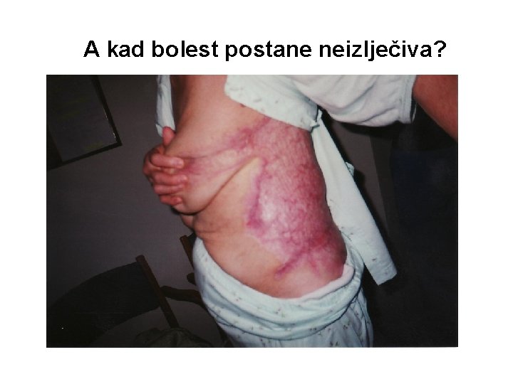 A kad bolest postane neizlječiva? 