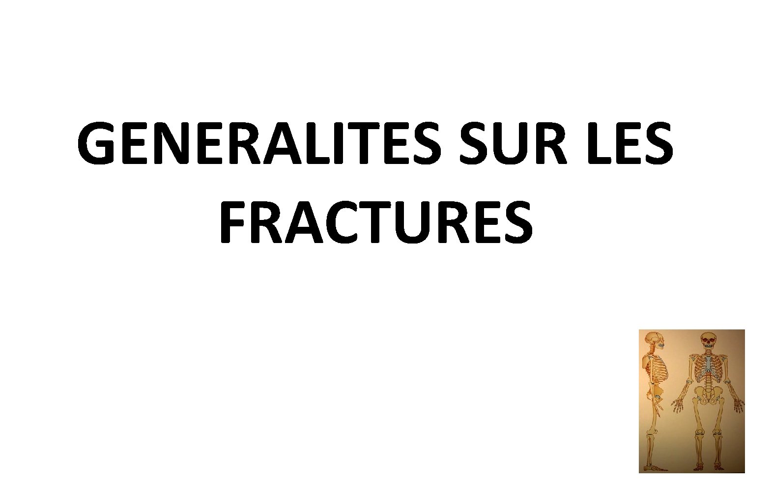 GENERALITES SUR LES FRACTURES GENERALITES SUR LES FRACTURES