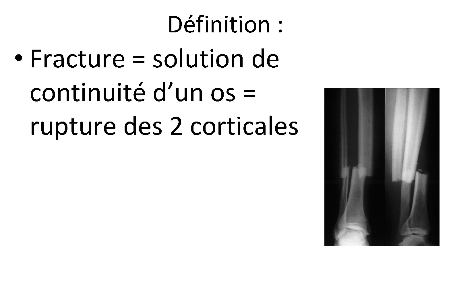 Définition : • Fracture = solution de continuité d’un os = rupture des 2 Définition : • Fracture = solution de continuité d’un os = rupture des 2