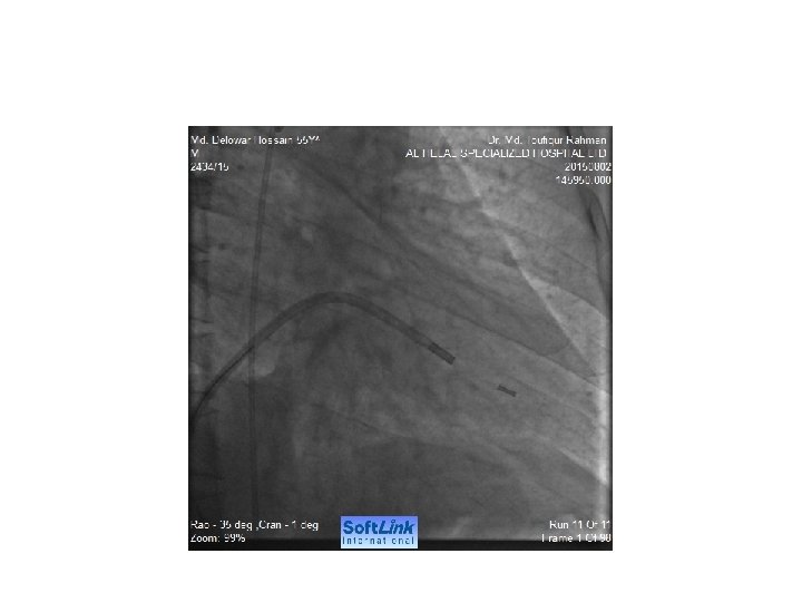 Ptmc Ed PTMC in Elderly A challenging case with complications