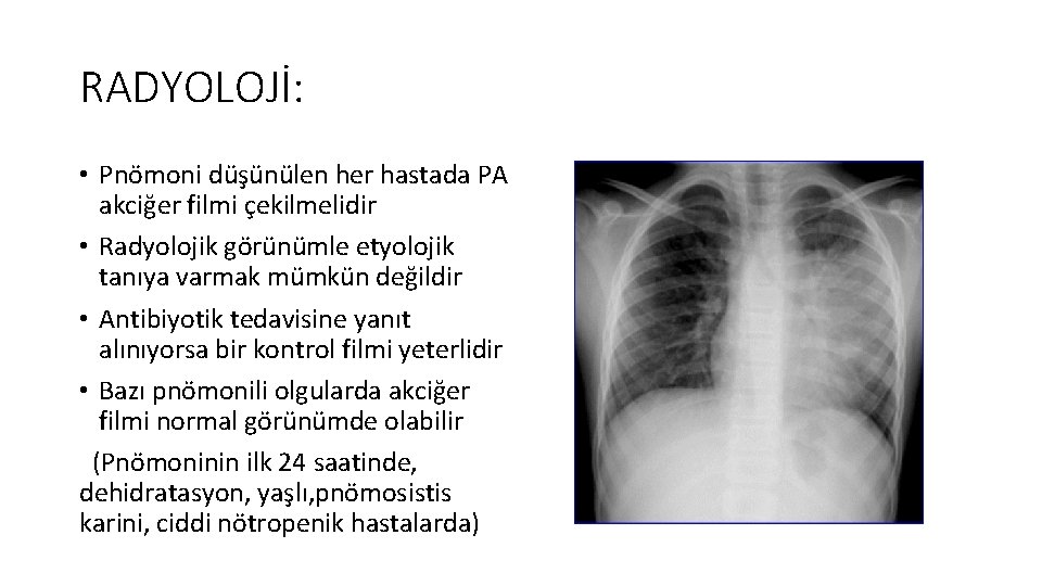 RADYOLOJİ: • Pnömoni düşünülen her hastada PA akciğer filmi çekilmelidir • Radyolojik görünümle etyolojik