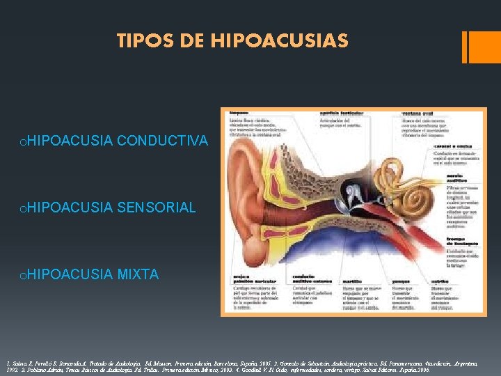 TIPOS DE HIPOACUSIAS o. HIPOACUSIA CONDUCTIVA o. HIPOACUSIA SENSORIAL o. HIPOACUSIA MIXTA 1. Salesa TIPOS DE HIPOACUSIAS o. HIPOACUSIA CONDUCTIVA o. HIPOACUSIA SENSORIAL o. HIPOACUSIA MIXTA 1. Salesa