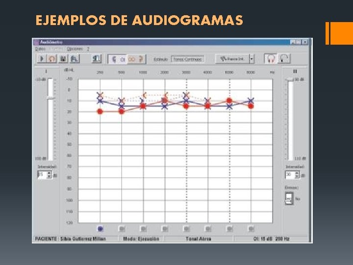 EJEMPLOS DE AUDIOGRAMAS EJEMPLOS DE AUDIOGRAMAS