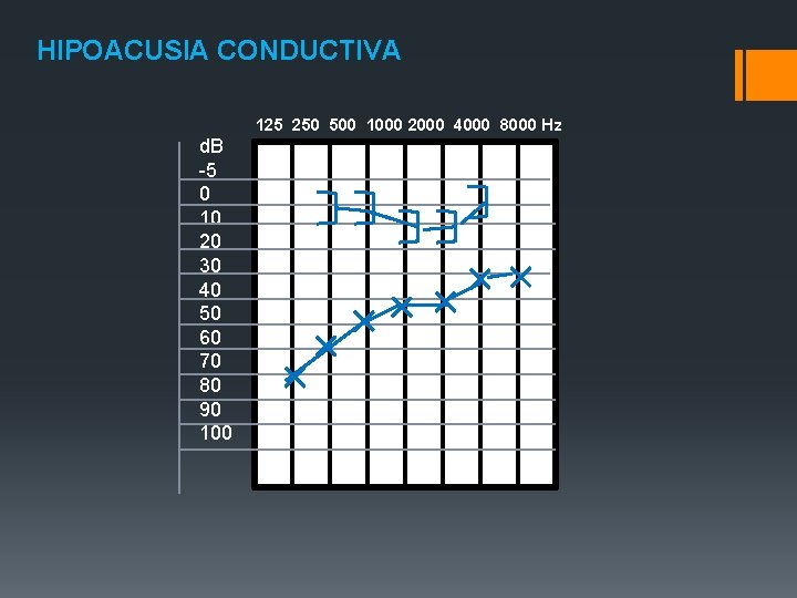 HIPOACUSIA CONDUCTIVA 125 250 500 1000 2000 4000 8000 Hz d. B -5 0 HIPOACUSIA CONDUCTIVA 125 250 500 1000 2000 4000 8000 Hz d. B -5 0