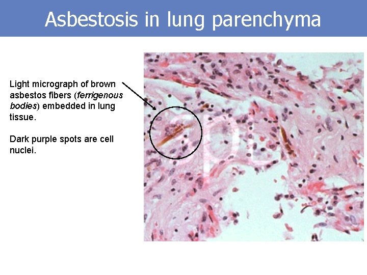 Asbestosis in lung parenchyma Light micrograph of brown asbestos fibers (ferrigenous bodies) embedded in