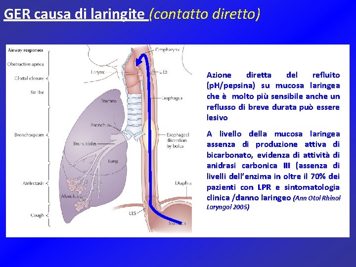 GER causa di laringite (contatto diretto) Azione diretta del refluito (p. H/pepsina) su mucosa