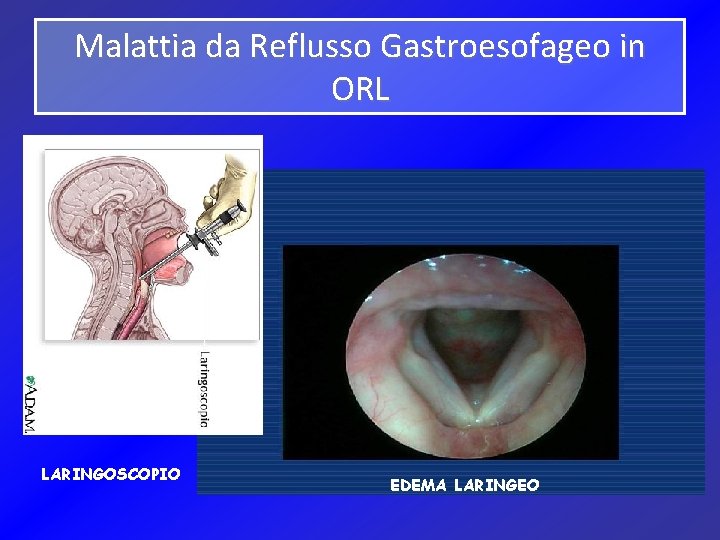 Malattia da Reflusso Gastroesofageo in ORL LARINGOSCOPIO EDEMA LARINGEO 