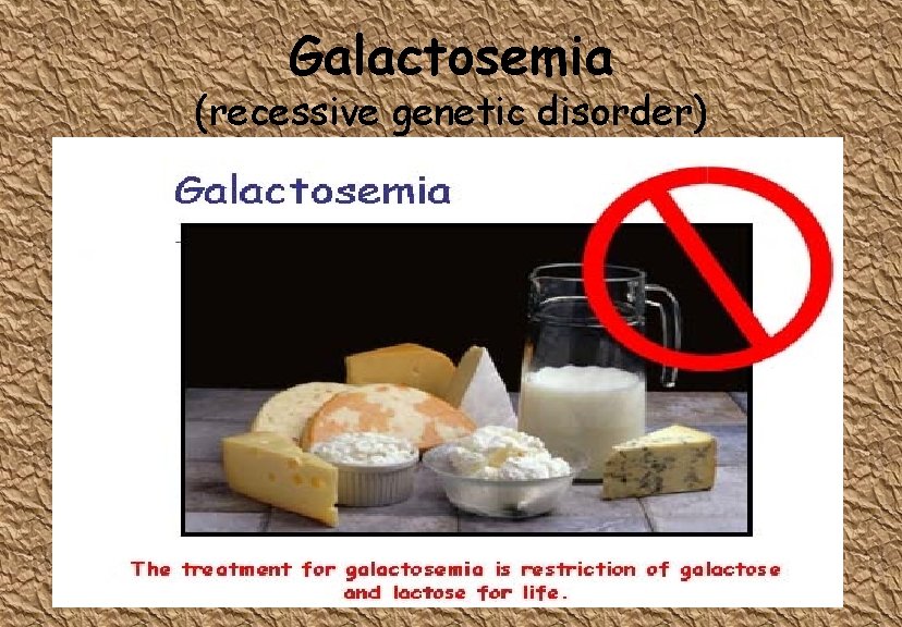 Galactosemia (recessive genetic disorder) Galactosemia (recessive genetic disorder)