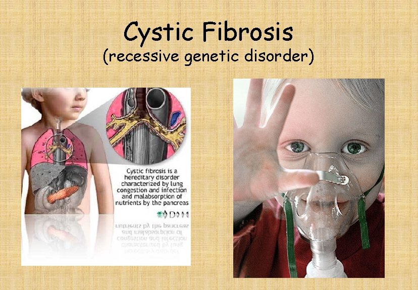 Cystic Fibrosis (recessive genetic disorder) 