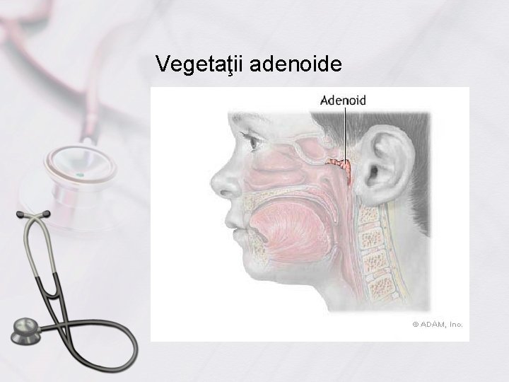 Vegetaţii adenoide 