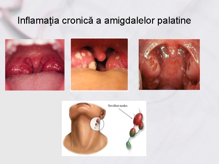 Inflamaţia cronică a amigdalelor palatine 