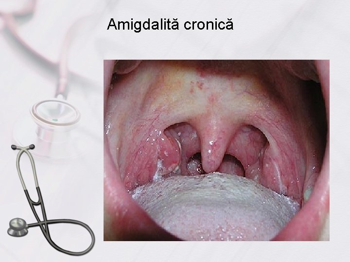 Amigdalită cronică 