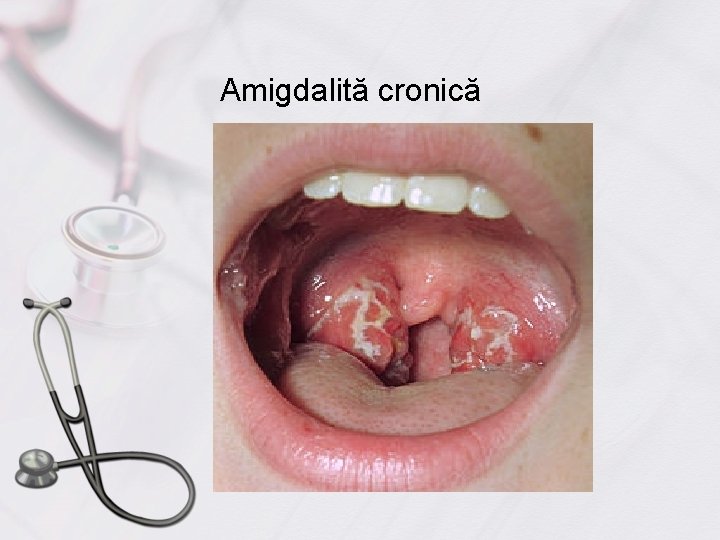 Amigdalită cronică 